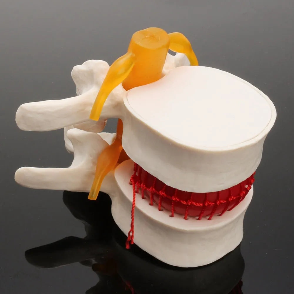 White PVC anatomical model of a herniated lumbar intervertebral disc for medical demonstration