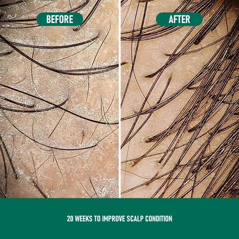 CH004 Minoxidil 5% Anti-Hair Loss Foam Mousse in 60ml canister for topical hair regrowth treatment
