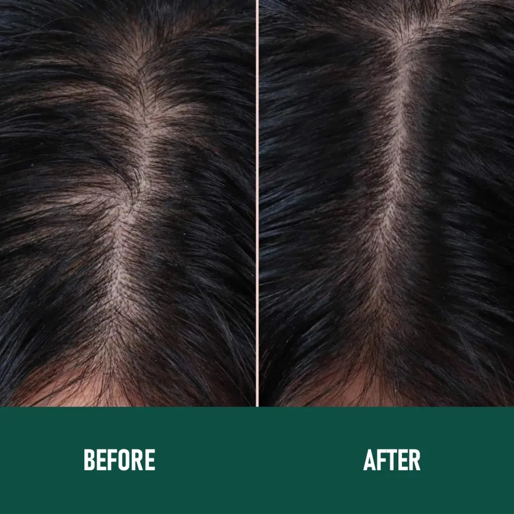 CH004 Minoxidil 5% Anti-Hair Loss Foam Mousse in 60ml canister for topical hair regrowth treatment