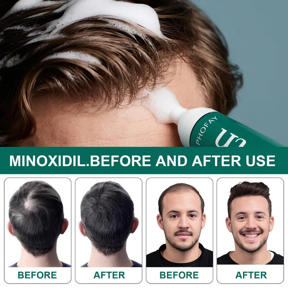 CH004 Minoxidil 5% Anti-Hair Loss Foam Mousse in 60ml canister for topical hair regrowth treatment
