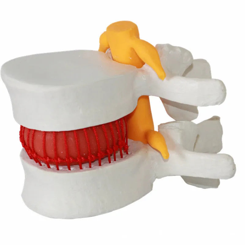 White PVC anatomical model of a herniated lumbar intervertebral disc for medical demonstration