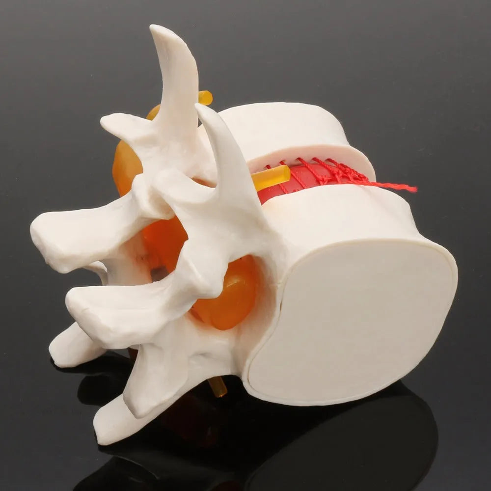White PVC anatomical model of a herniated lumbar intervertebral disc for medical demonstration