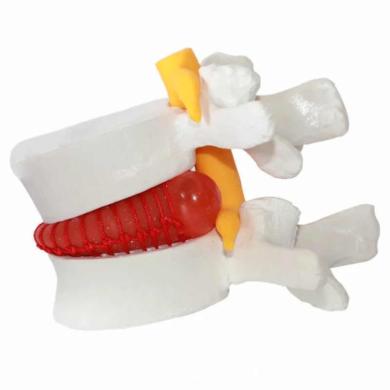 White PVC anatomical model of a herniated lumbar intervertebral disc for medical demonstration