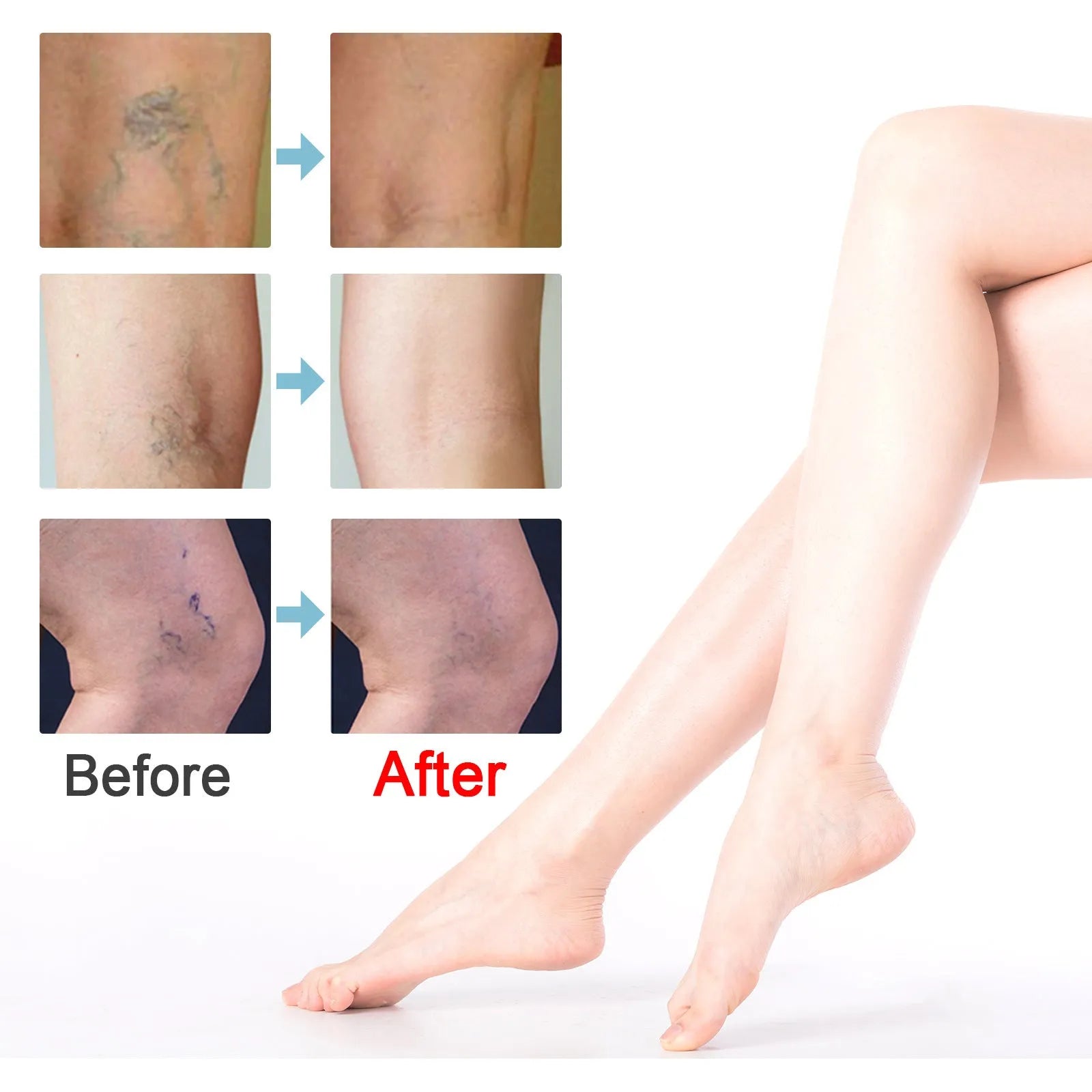 20g tube of vein repair cream for varicose and thread veins