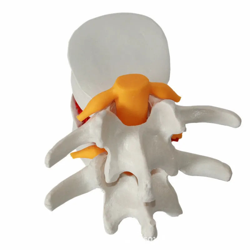 White PVC anatomical model of a herniated lumbar intervertebral disc for medical demonstration