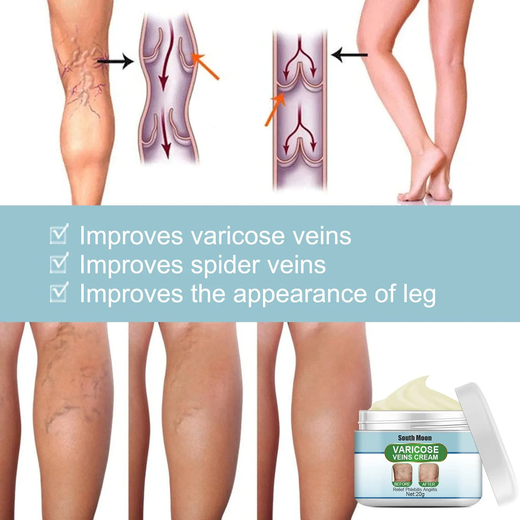 20g tube of vein repair cream for varicose and thread veins