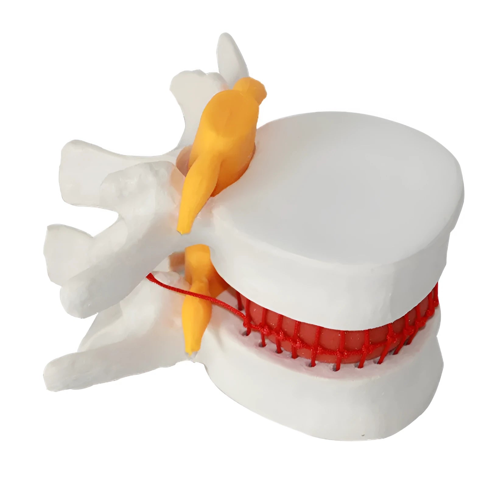 White PVC anatomical model of a herniated lumbar intervertebral disc for medical demonstration
