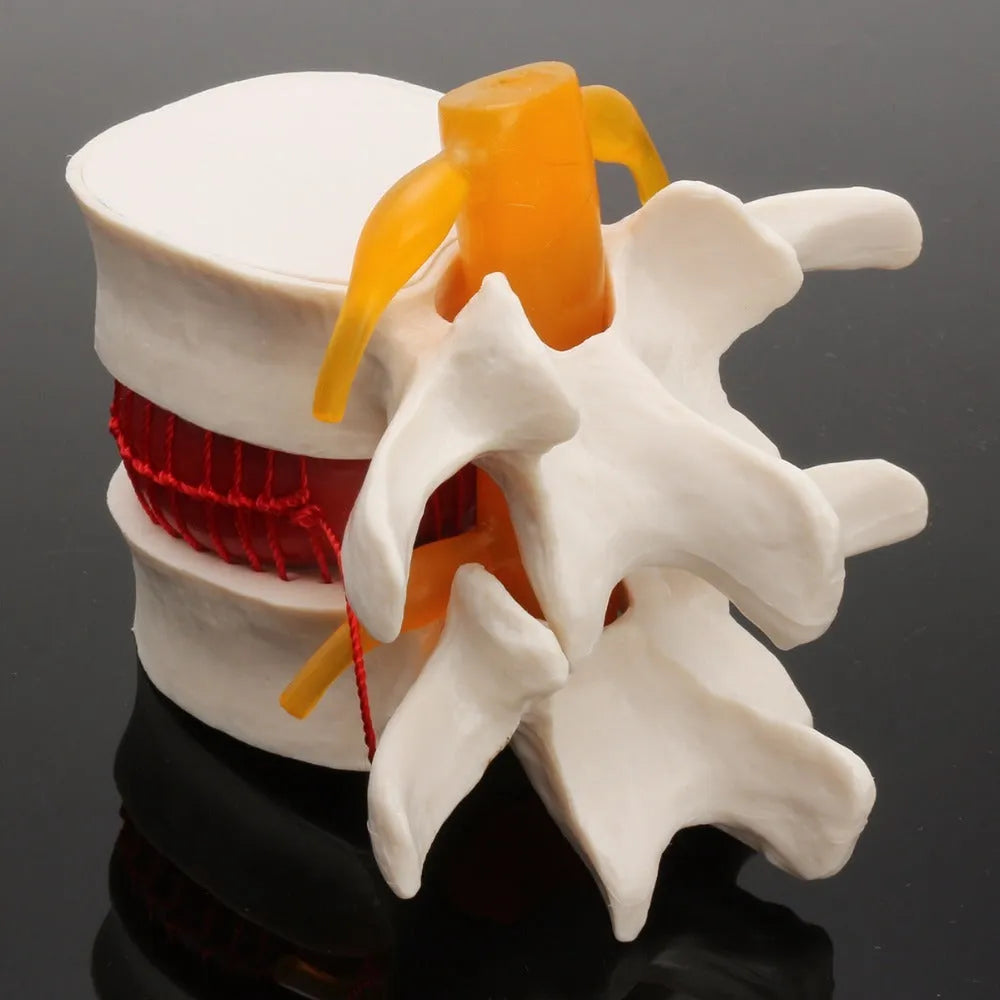 White PVC anatomical model of a herniated lumbar intervertebral disc for medical demonstration