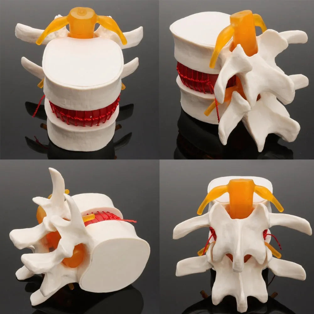White PVC anatomical model of a herniated lumbar intervertebral disc for medical demonstration