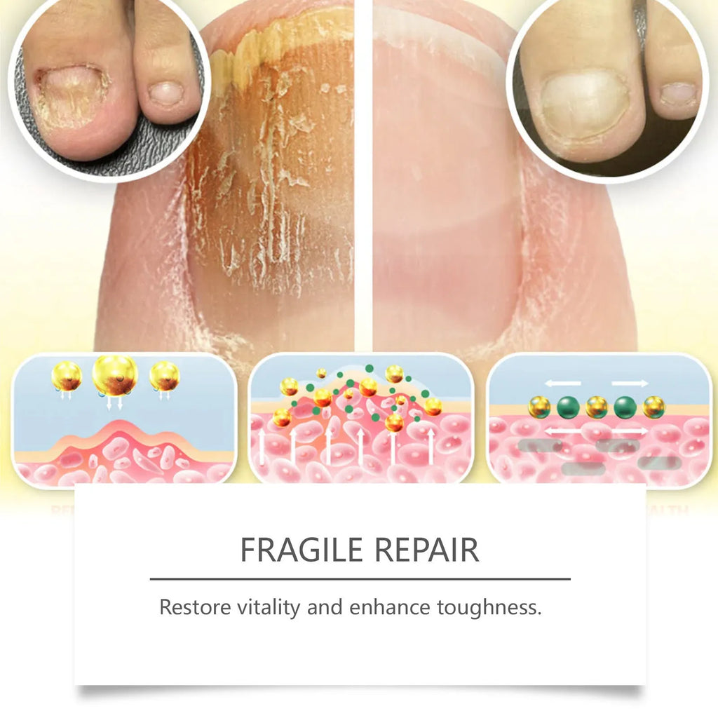 50ml bottle of nail fungus care solution with bee venom and peppermint oil formula